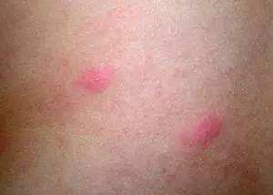 梦见自己被虫咬